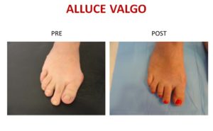 alluce valgo