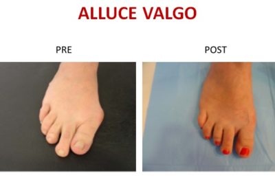 alluce valgo