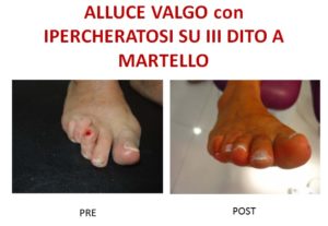 alluce valgo con ipercheratosi su terzo dito a martello