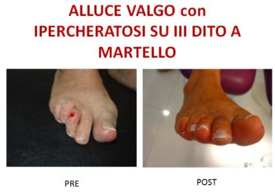 alluce valgo con ipercheratosi su terzo dito a martello