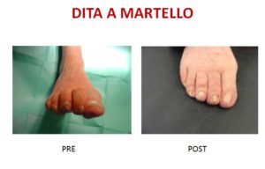 dita a martello