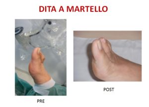 dita a martello