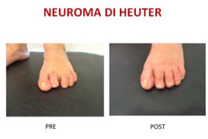 neuroma di Heuter