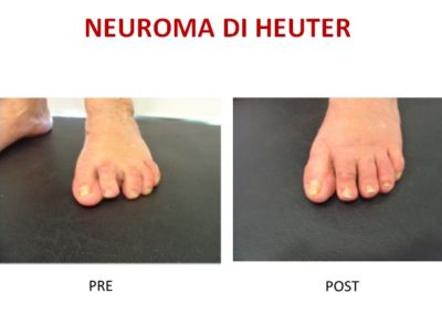 neuroma di Heuter