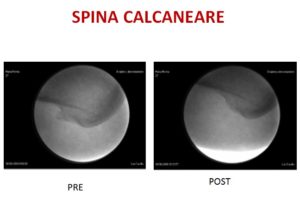 spina calcanerare