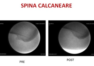 spina calcanerare