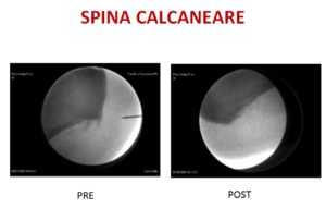 spina calcaneare