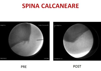 spina calcaneare