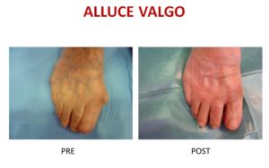 alluce valgo