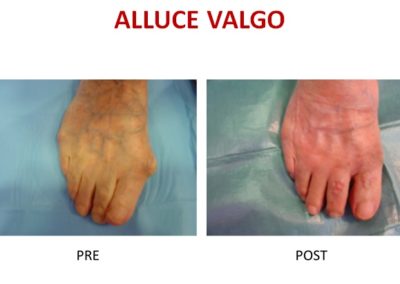 alluce valgo