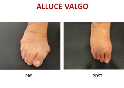 alluce valgo