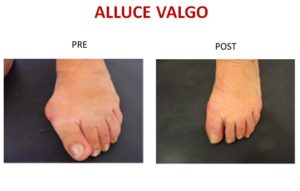 alluce valgo