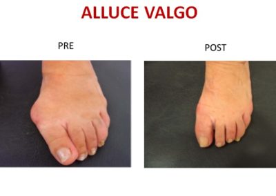 alluce valgo