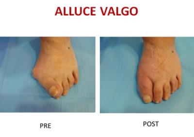 alluce valgo