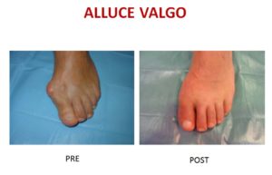 alluce valgo