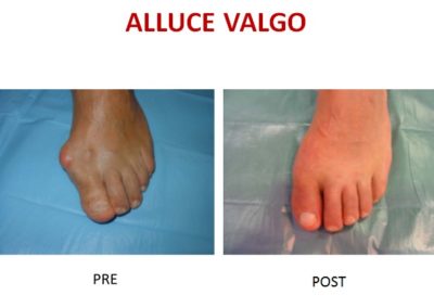 alluce valgo